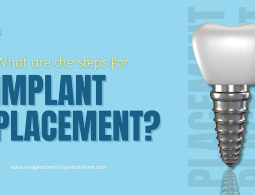 Implant placement – Charlotte, NC