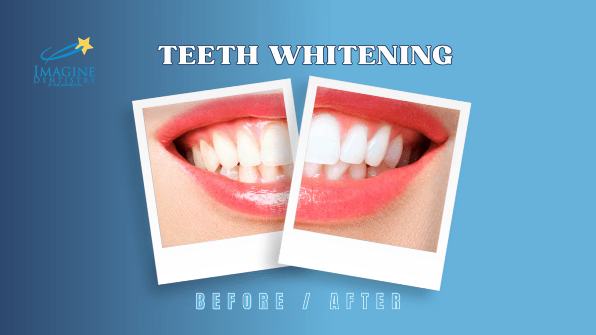 Teeth Whitening Charlotte, NC