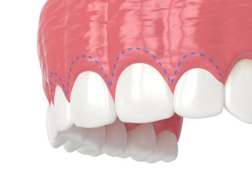 5 Indicators That You Would Benefit From Treatment For Your Gummy Smile