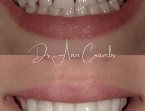 Post-Orthodontic Refinement: Using Bioclear to Perfect Your Smile After Braces or Clear Aligners