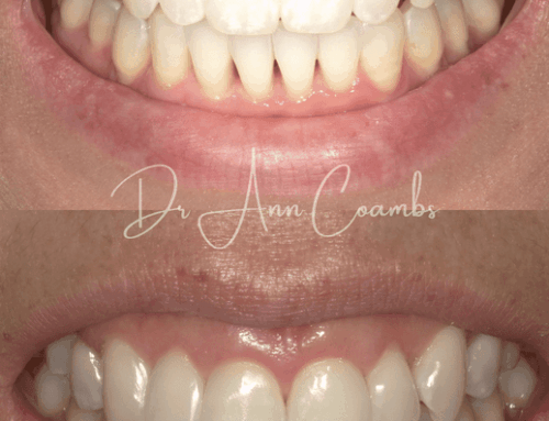 Black Triangle Closure: How Bioclear Rejuvenation Transforms Your Smile