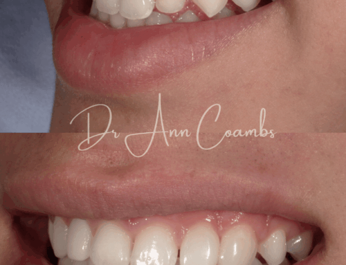 Bioclear vs. Traditional Bonding: Why Modern Dentistry Is Choosing Bioclear