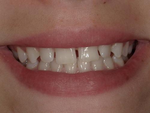 Kappy BEFORE - Imagine Dentistry