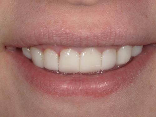 Nolan AFTER - Imagine Dentistry