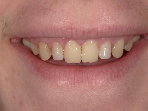 Nolan BEFORE - Imagine Dentistry