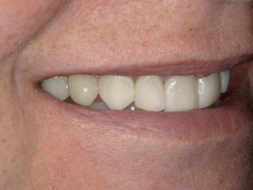 Olga AFTER - Imagine Dentistry