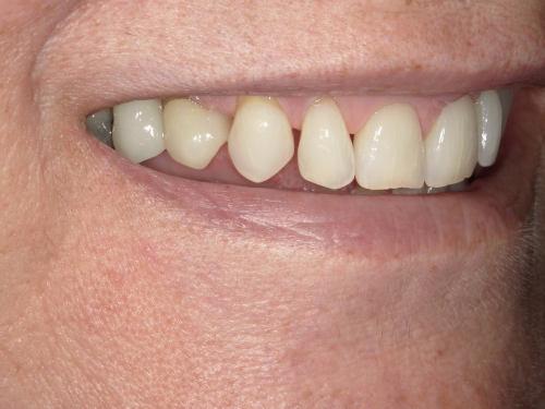 Olga BEFORE - Imagine Dentistry