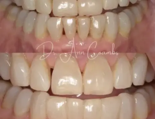 Understanding the Bioclear Method: What to Expect During Your Treatment
