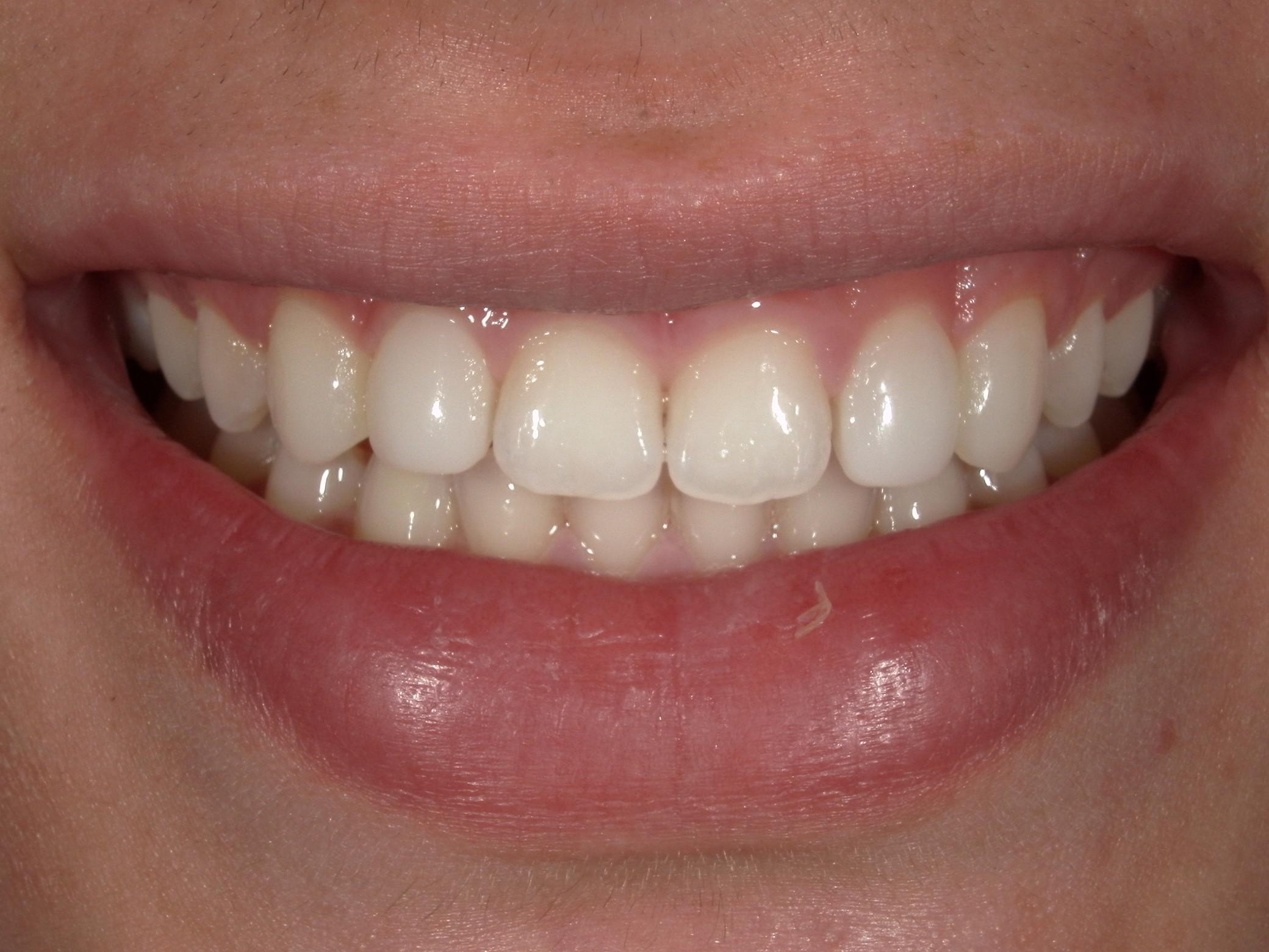after - Imagine Dentistry